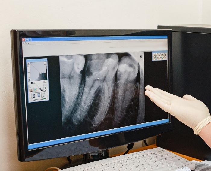 Dentist gesturing to computer screen showing x rays of teeth