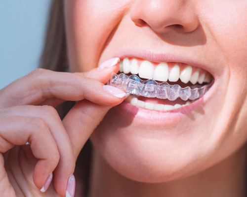 Woman with clear aligners
