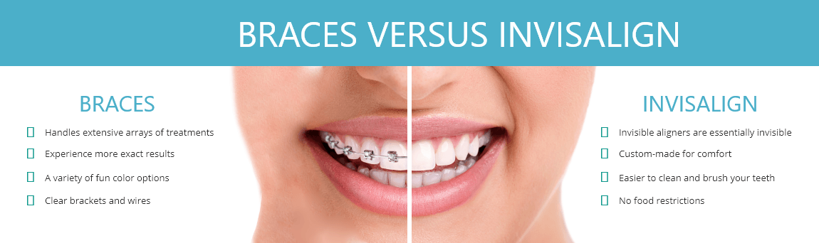 Braces versus Invisalign chart