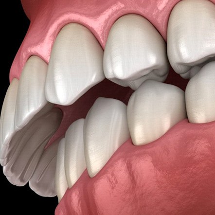 Overbite