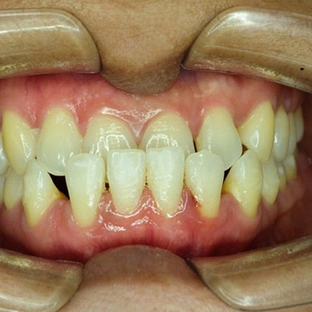 Underbite