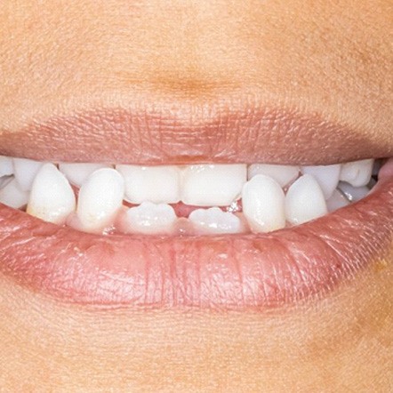 Crossbite