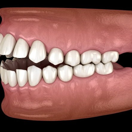 Model of open bite
