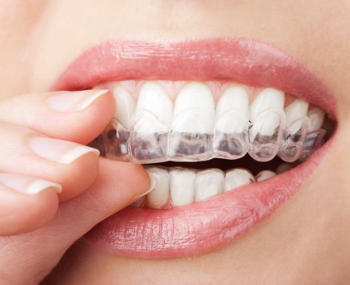 Close up of person placing Invisalign clear aligner in their mouth