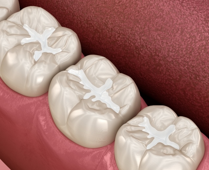 Illustrated row of teeth with white fillings