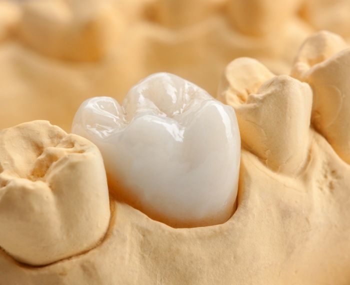 Dental crown over a tooth in a model of the mouth