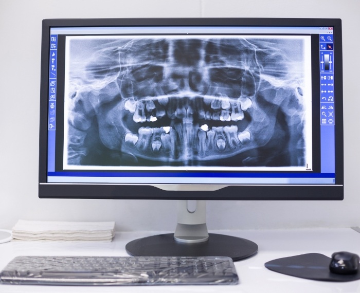 Computer screen showing x rays of teeth