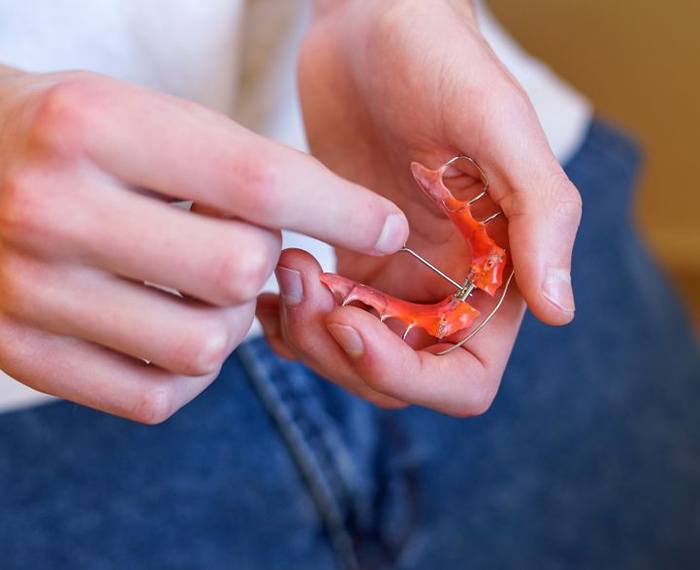 Hands holding palatal expander for Phase 1 orthodontics