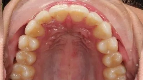 Close up of row of straightened teeth