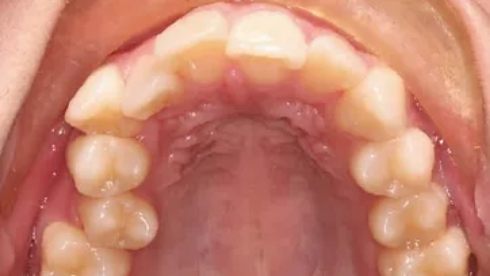 Close up of row of misaligned teeth