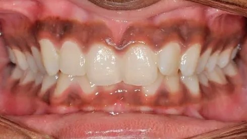 Close up of mouth with misaligned teeth