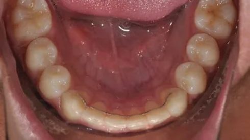 Close up of row of well aligned teeth