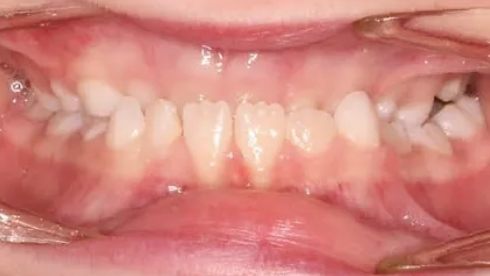 Close up of child with misaligned teeth