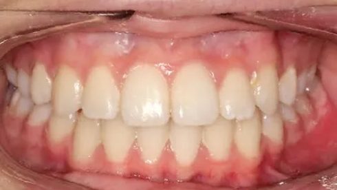 Close up of mouth after fixing crowded teeth