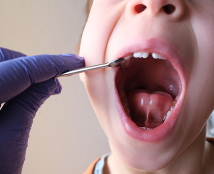 Child in Pleasanton with a tongue-tie