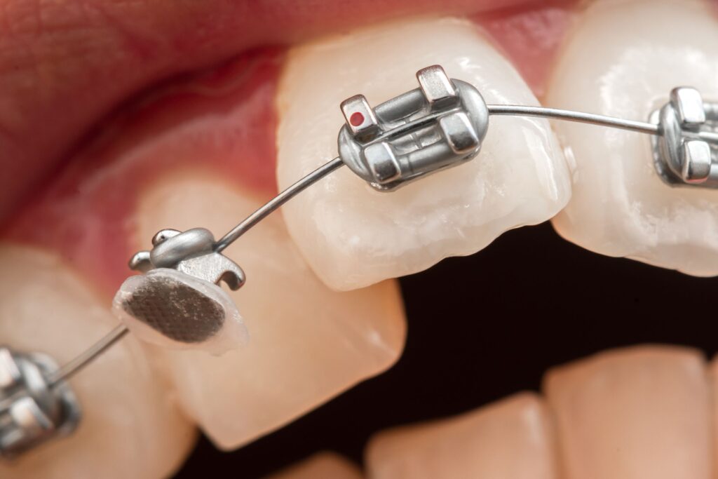 Close up of braces on teeth with a dislodged bracket